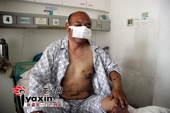 新疆沙灣村民山中撿玉遭棕熊攻擊 鼻子、上嘴唇被咬掉撿回一命（圖）