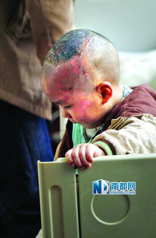 1月8日下午，小寶頭上和臉上都是傷痕。