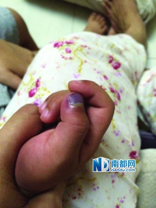 小逸手指被夾傷。