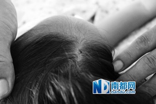 女童頭上被扎的針孔（圓圈處）。賈先生說，被扎不到三秒鐘，女兒就昏了。