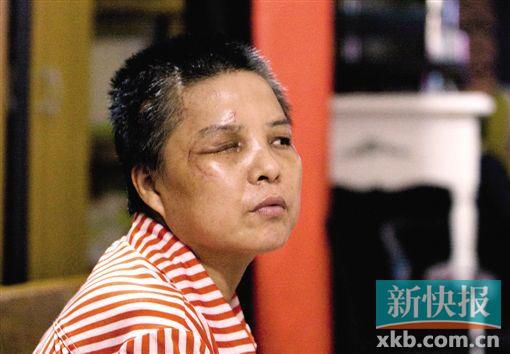 4月初,趙女士遭人搶劫并被打傷,現(xiàn)今右眼失明,頭部被縫100多針。記者 畢志毅/攝