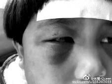 6月2日，網(wǎng)曝渭南市臨渭區(qū)一不滿5歲的女童遭奶奶毆打，眼圈青腫，引起網(wǎng)友關(guān)注，但孩子父母和爺爺均稱是摔倒導(dǎo)致。相關(guān)部門介入調(diào)查發(fā)現(xiàn)確為奶奶毆打所致，鑒于其身體原因已進(jìn)行批評教育。