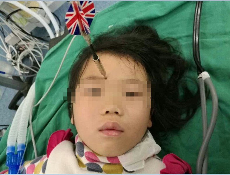 十多公分長的飛鏢穩(wěn)穩(wěn)地 ” 定 ” 在了一名六歲半的女童額頭上，小青一家人凌晨從長順趕到貴醫(yī)附院急診室時(shí)，看到如此慘烈的情況，接診醫(yī)生都嚇了一跳。詳細(xì)詢問下得知，原來是七歲的哥哥和六歲半的表妹在玩耍時(shí)，哥哥不慎將路邊撿來的真飛鏢扎到了妹妹的額頭上。