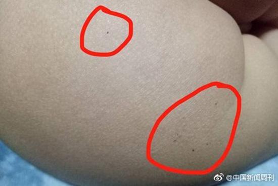 據(jù)多名紅黃藍(lán)(新天地分園)家長反映，孩子腿部、屁股、腋下出現(xiàn)針眼。