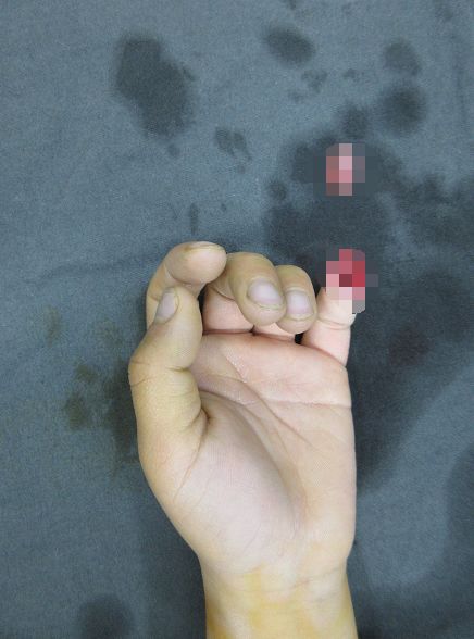 嚇哭！6歲男孩被夾斷手指 罪魁禍?zhǔn)拙故切７? oldsrc=
