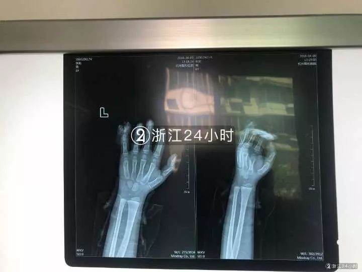 嚇哭！6歲男孩被夾斷手指 罪魁禍?zhǔn)拙故切７? oldsrc=