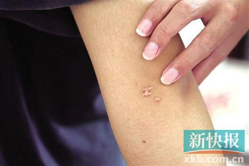 取出針后李星兒手臂留下了傷口。新快報(bào)記者 張國(guó)鋒/攝