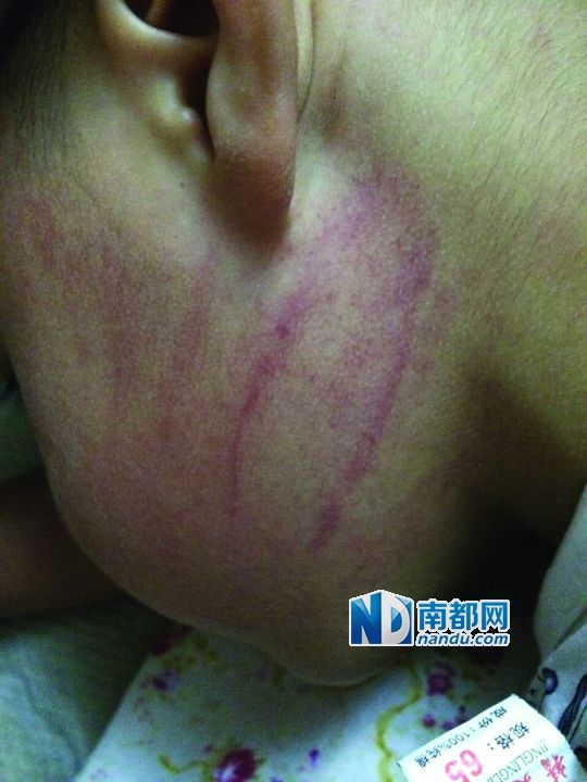 小逸臉上淤痕清晰可見。