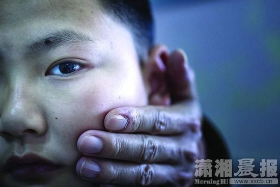 1月13日，小玨的父親心疼地摸著兒子的臉。
