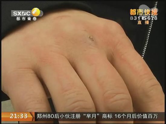 說到這足療拔罐，估計(jì)大伙都不陌生，但是想起4號(hào)晚上的拔罐的經(jīng)歷，呂先生現(xiàn)在想起來，還心有余悸。