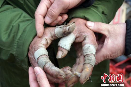 圖為由于常年拾荒，老人雙手布滿傷口。周小云 攝